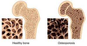osteoporoza kości